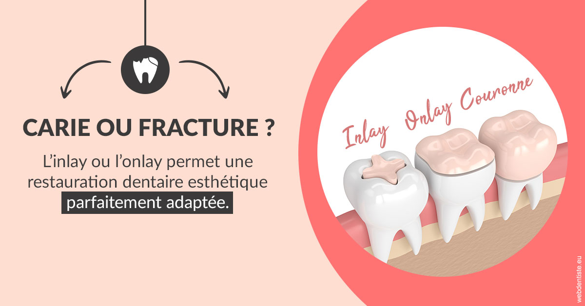 https://www.cabinet-dentaire-hollender-raybaut.fr/T2 2023 - Carie ou fracture 2