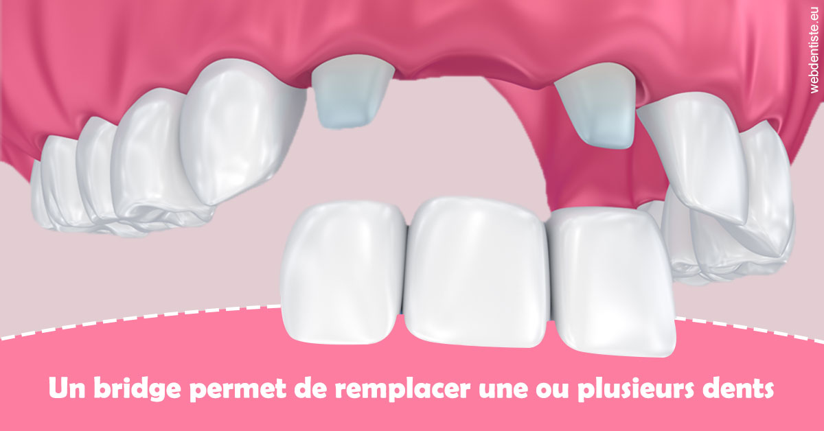 https://www.cabinet-dentaire-hollender-raybaut.fr/Bridge remplacer dents 2