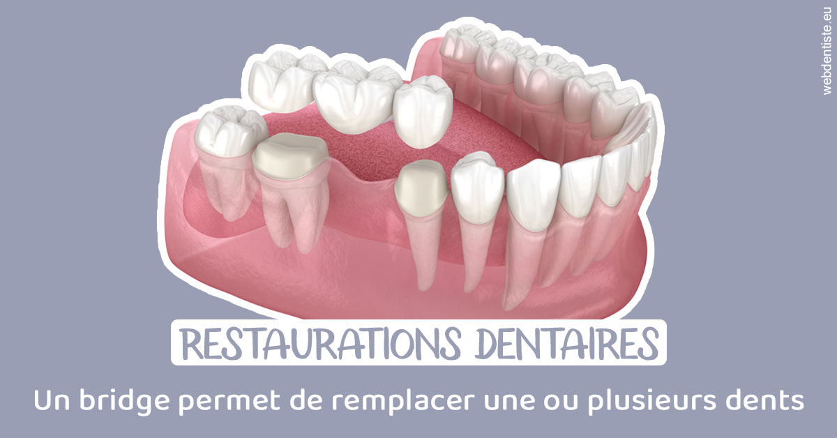https://www.cabinet-dentaire-hollender-raybaut.fr/Bridge remplacer dents 1