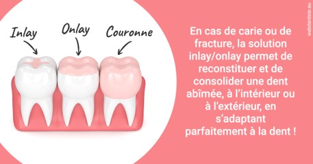 https://www.cabinet-dentaire-hollender-raybaut.fr/L'INLAY ou l'ONLAY 2