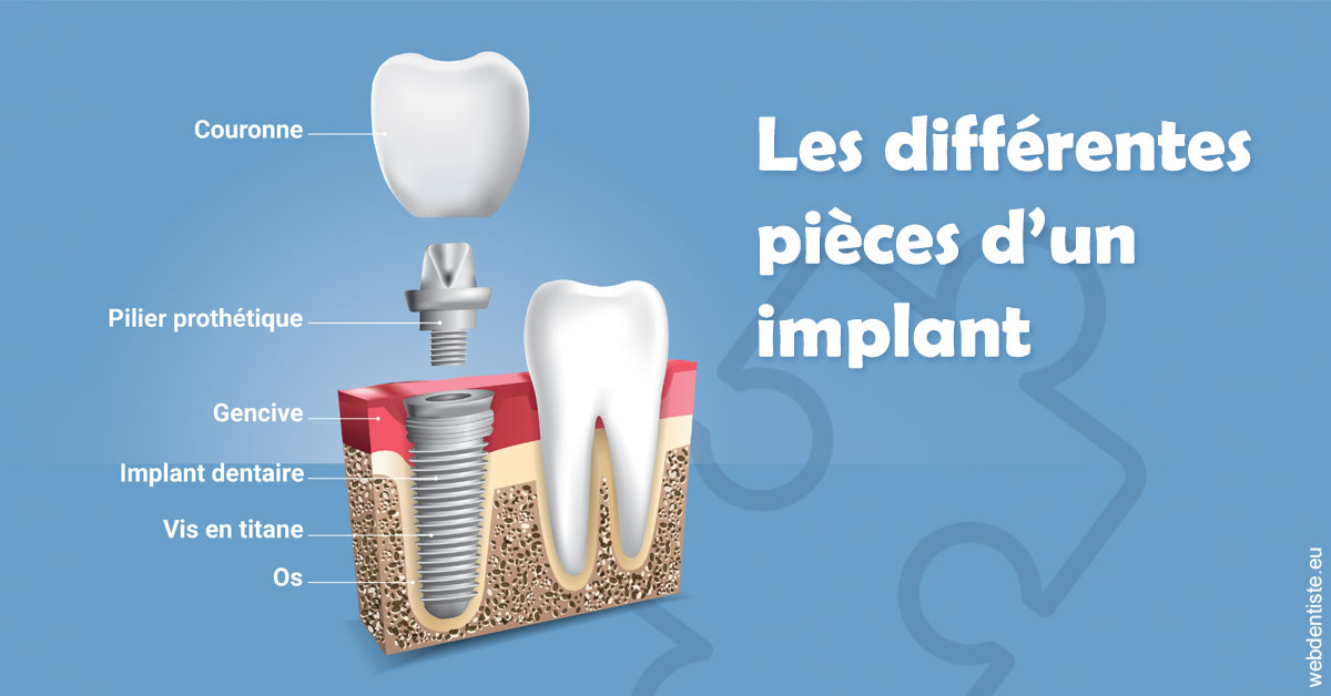 https://www.cabinet-dentaire-hollender-raybaut.fr/Les différentes pièces d’un implant 1