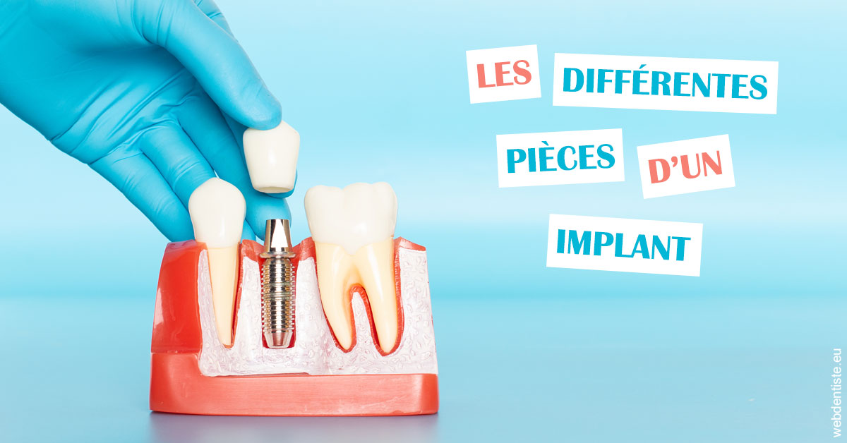 https://www.cabinet-dentaire-hollender-raybaut.fr/Les différentes pièces d’un implant 2